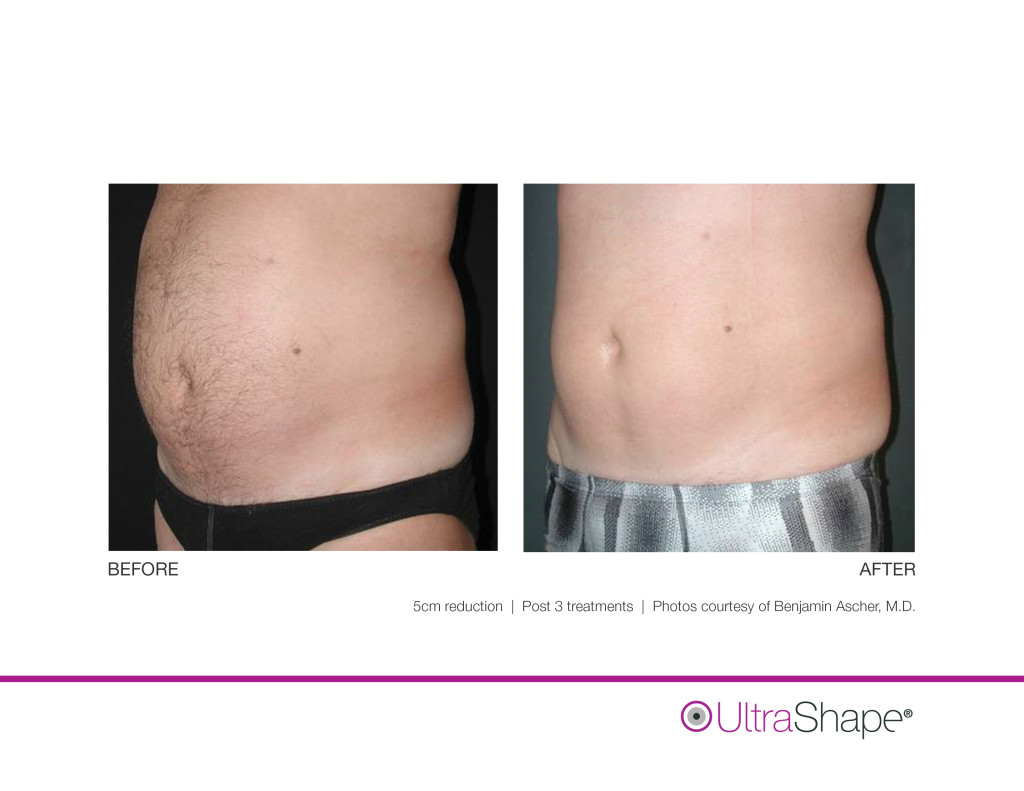 UltraShape-5cm-Ascher