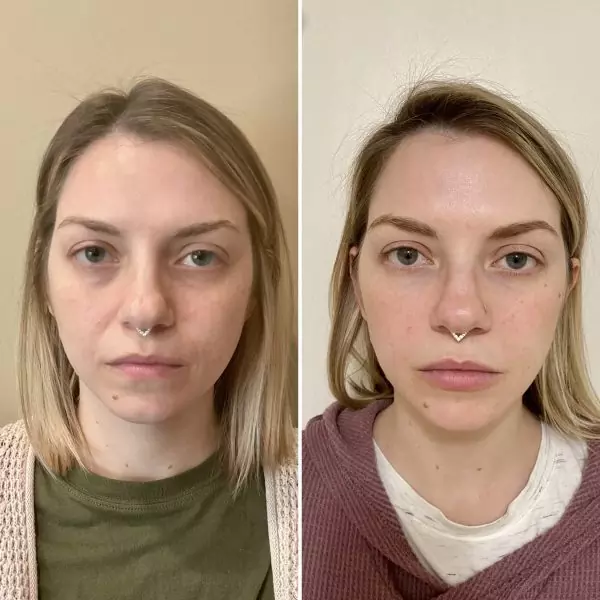 Filler and Botox cosmetic treatment results