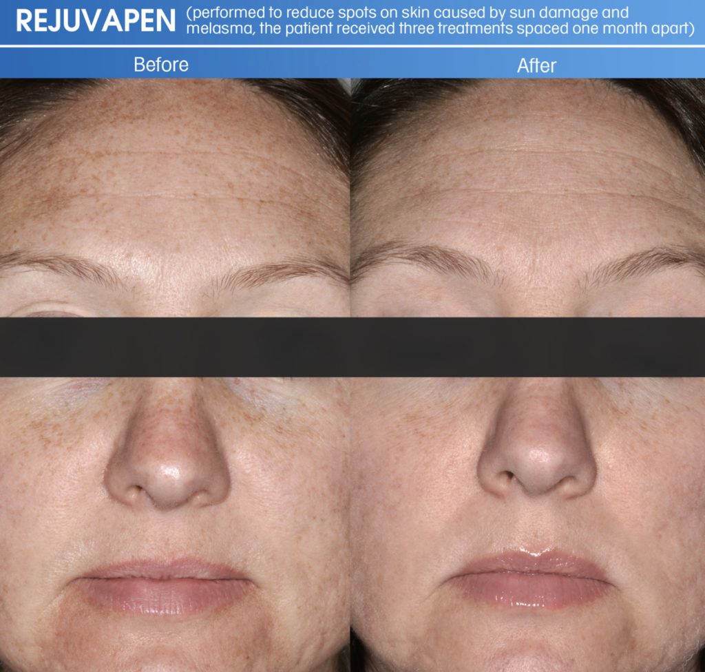 Rejuvapen microneedling for smoother firmer skin