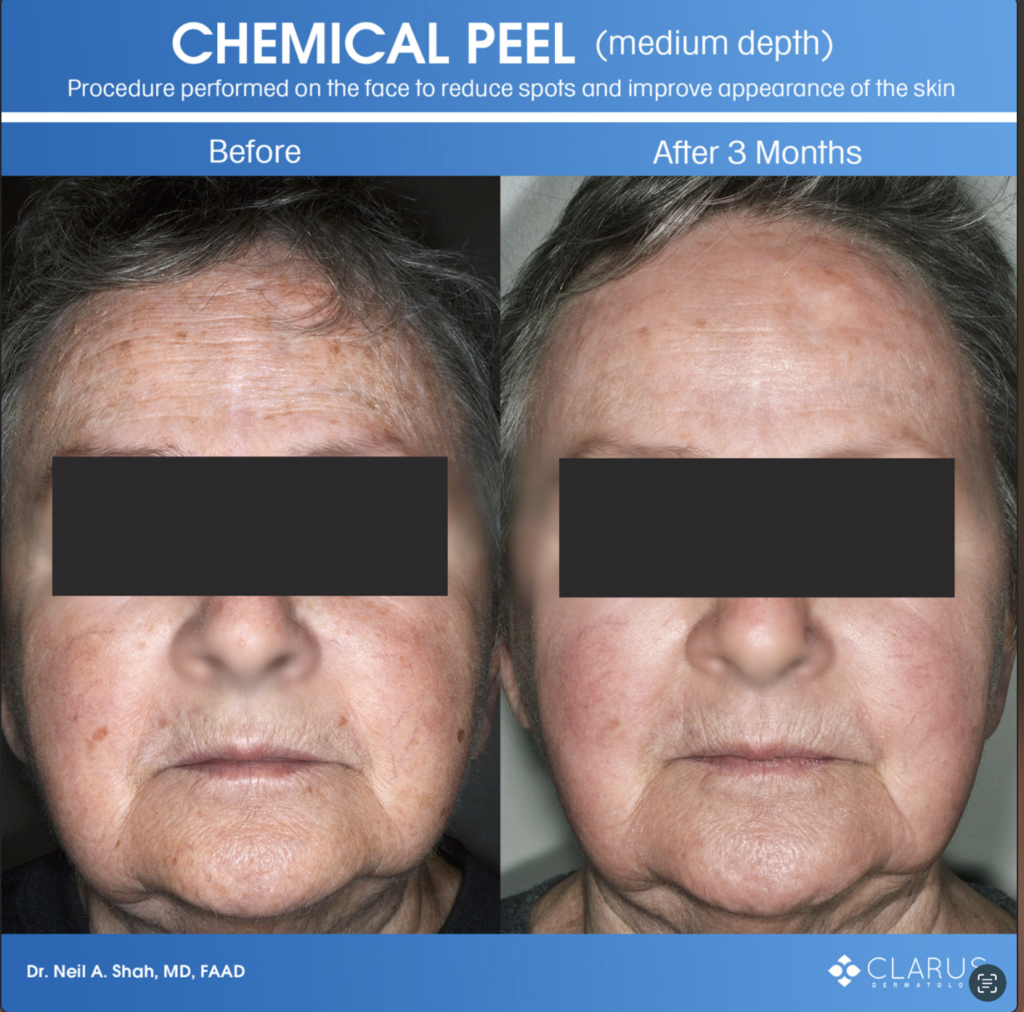 Chemical peel on face reducing spots and improving skin appearance