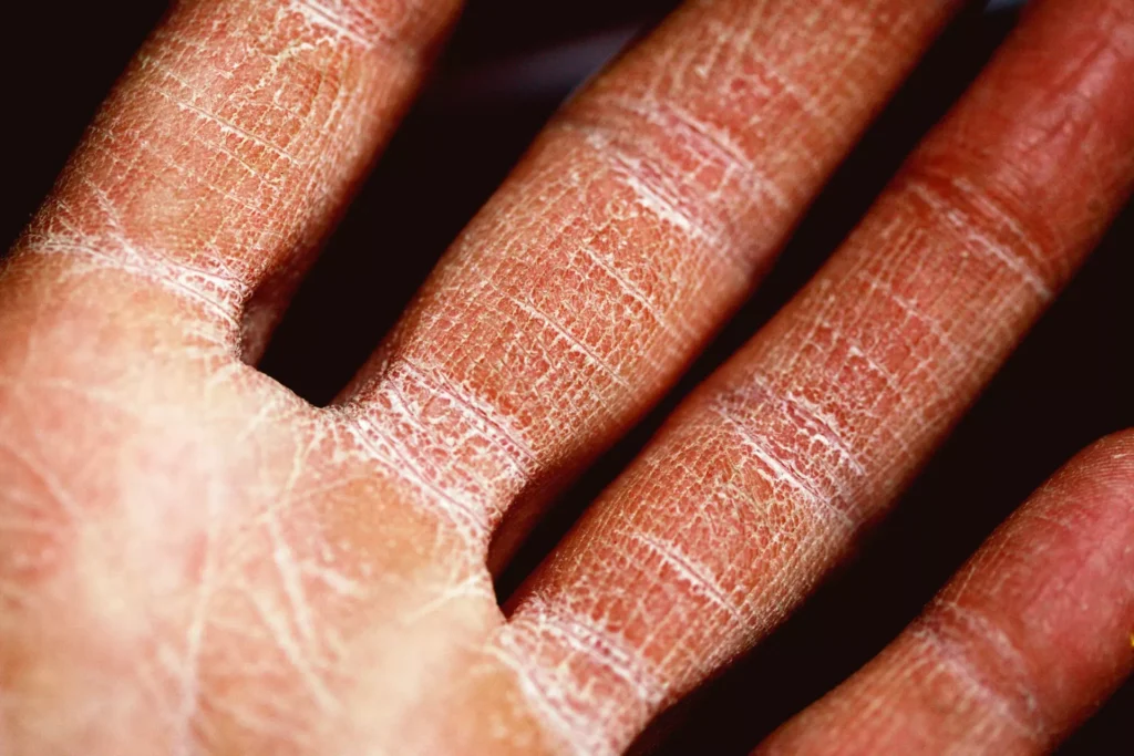 Psoriasis and eczema treatment tips for cold weather