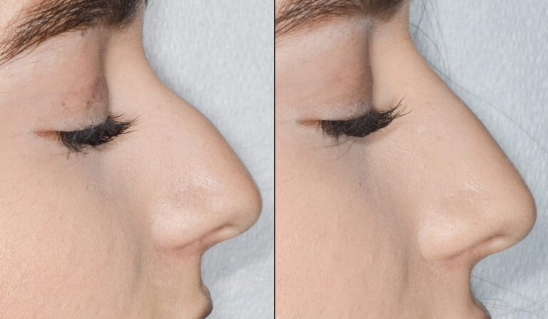 Liquid Rhinoplasty