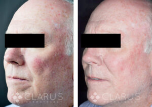 Rosacea treatment before and after results