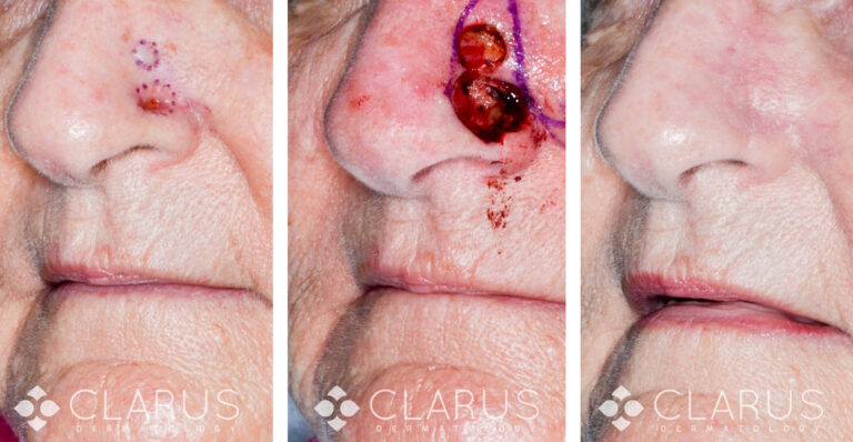 Mohs Surgery - BCC Flap Reconstruction