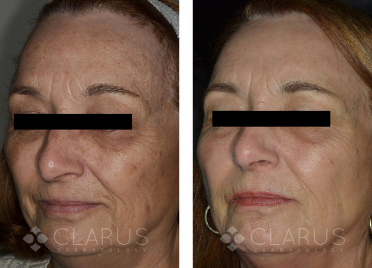 Multi-Treatments for Aging and Sun Damage