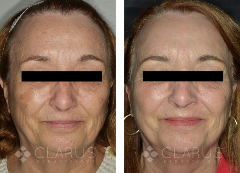 Multi-Treatments for Aging and Sun Damage