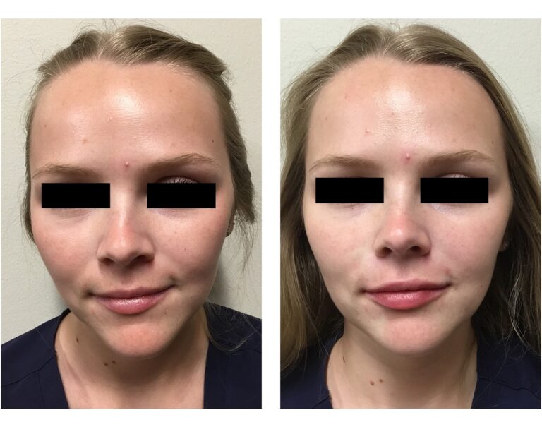Filler/Botox